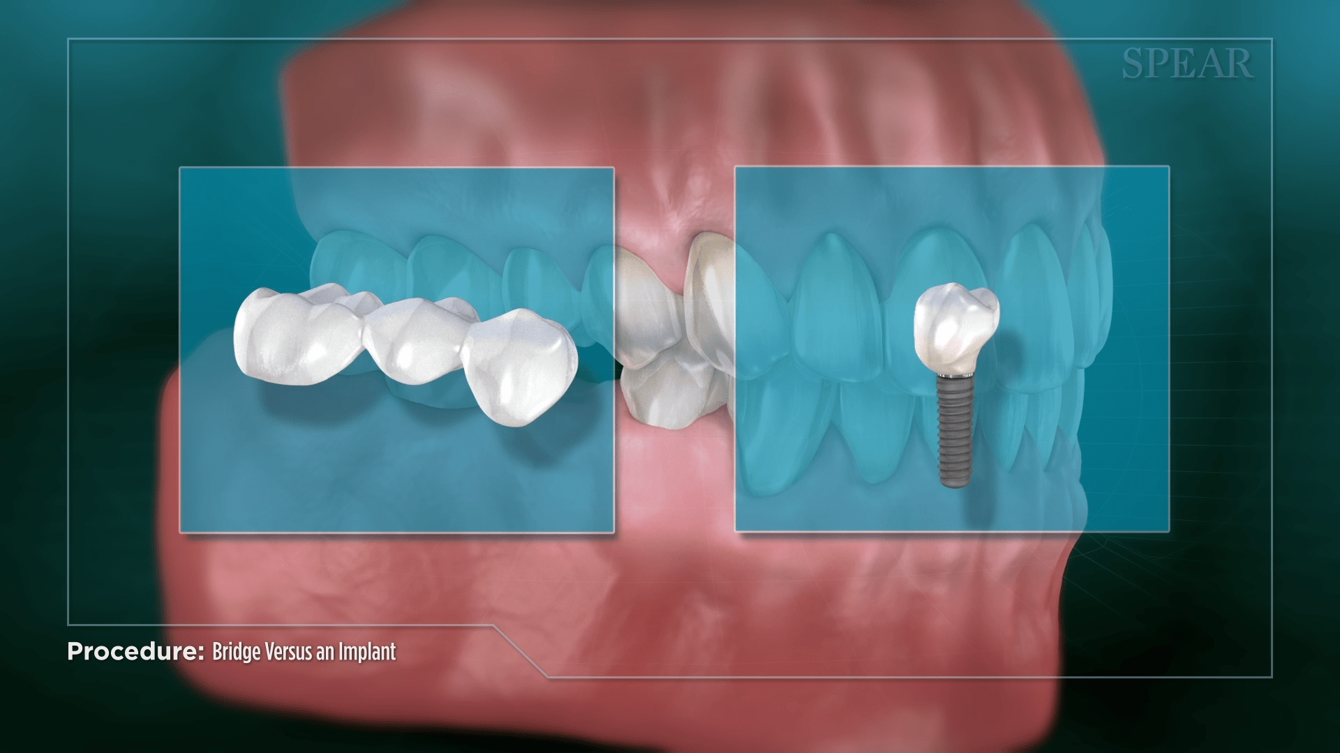 Bridge and Dental Implants