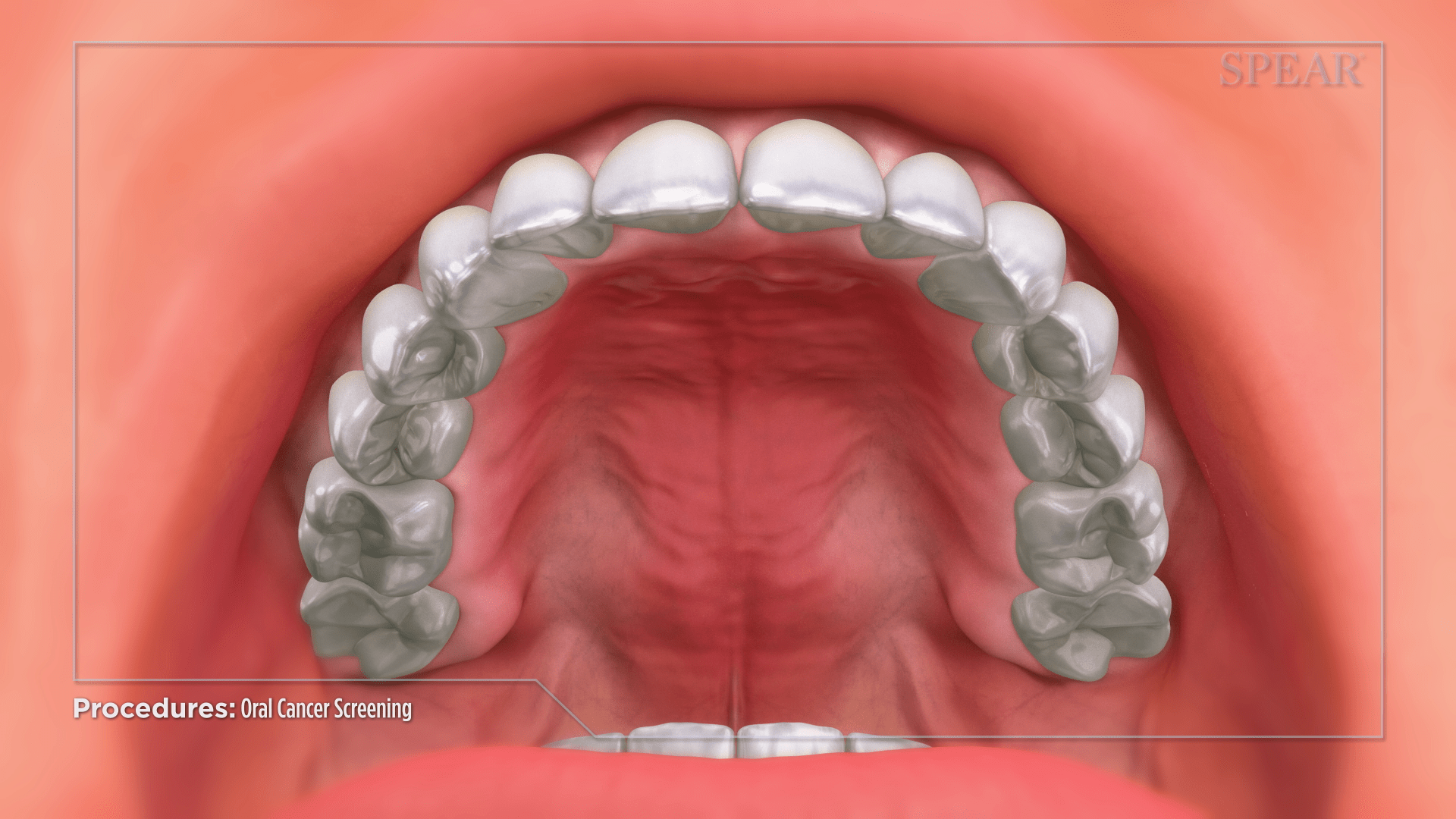Mouth Inspection for Oral Cancer