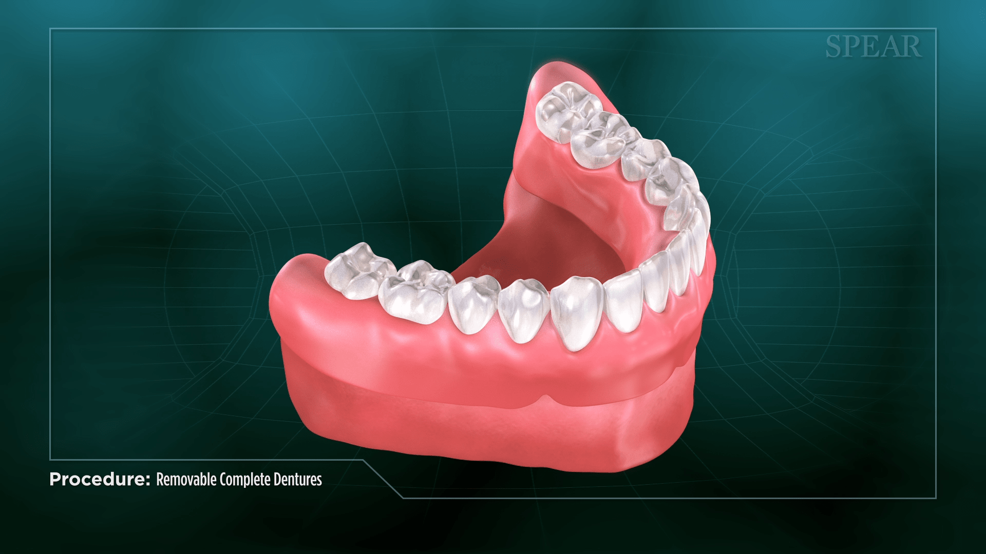 Removable Denture Mounting