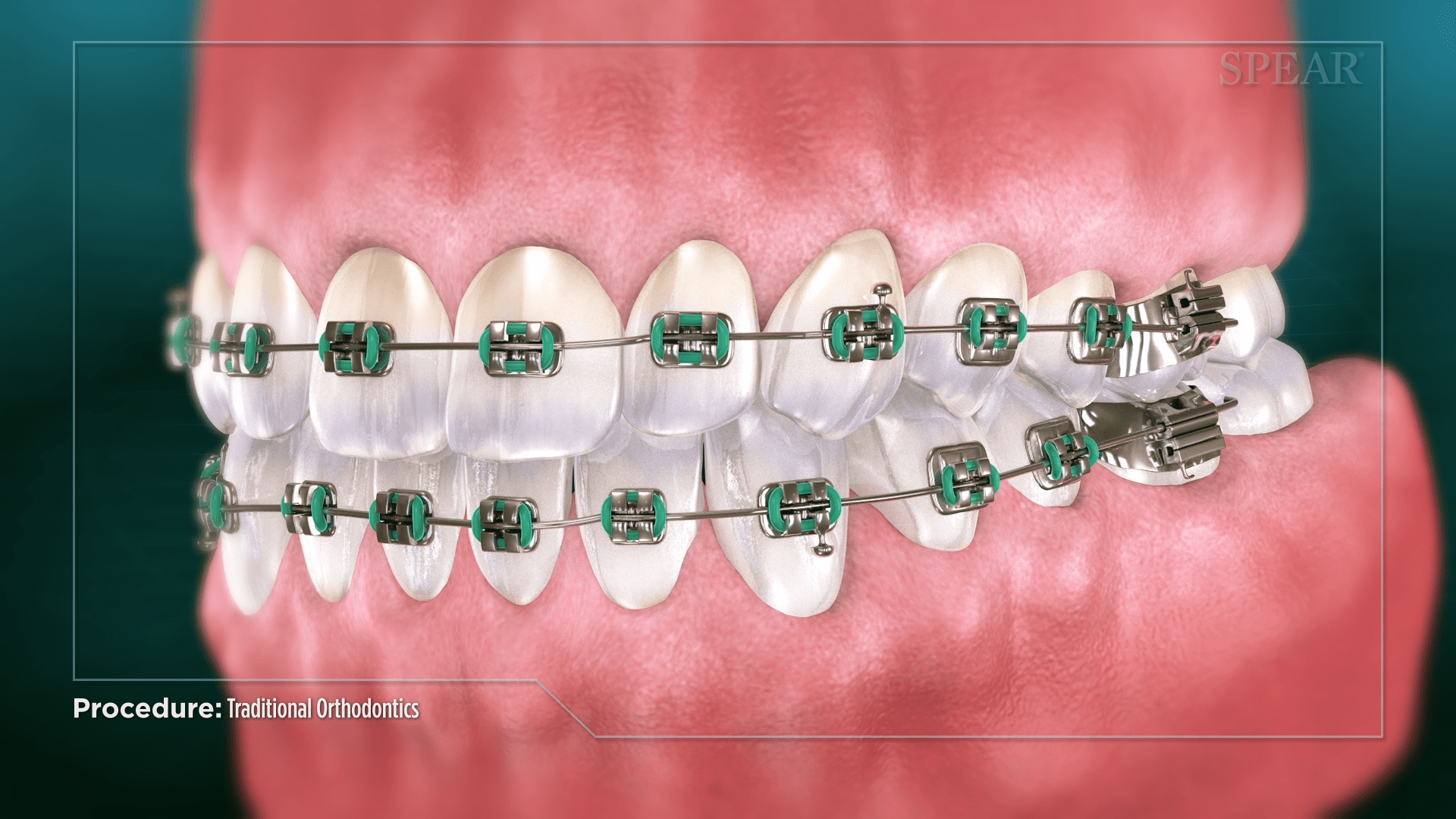 Orthodontic Treatment Over Conventional Dental Methods