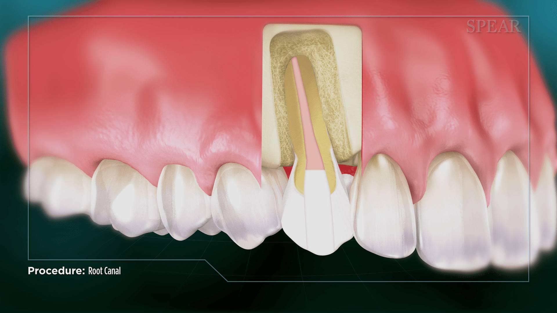 Sealing Material Filling at Lifetime Dentistry