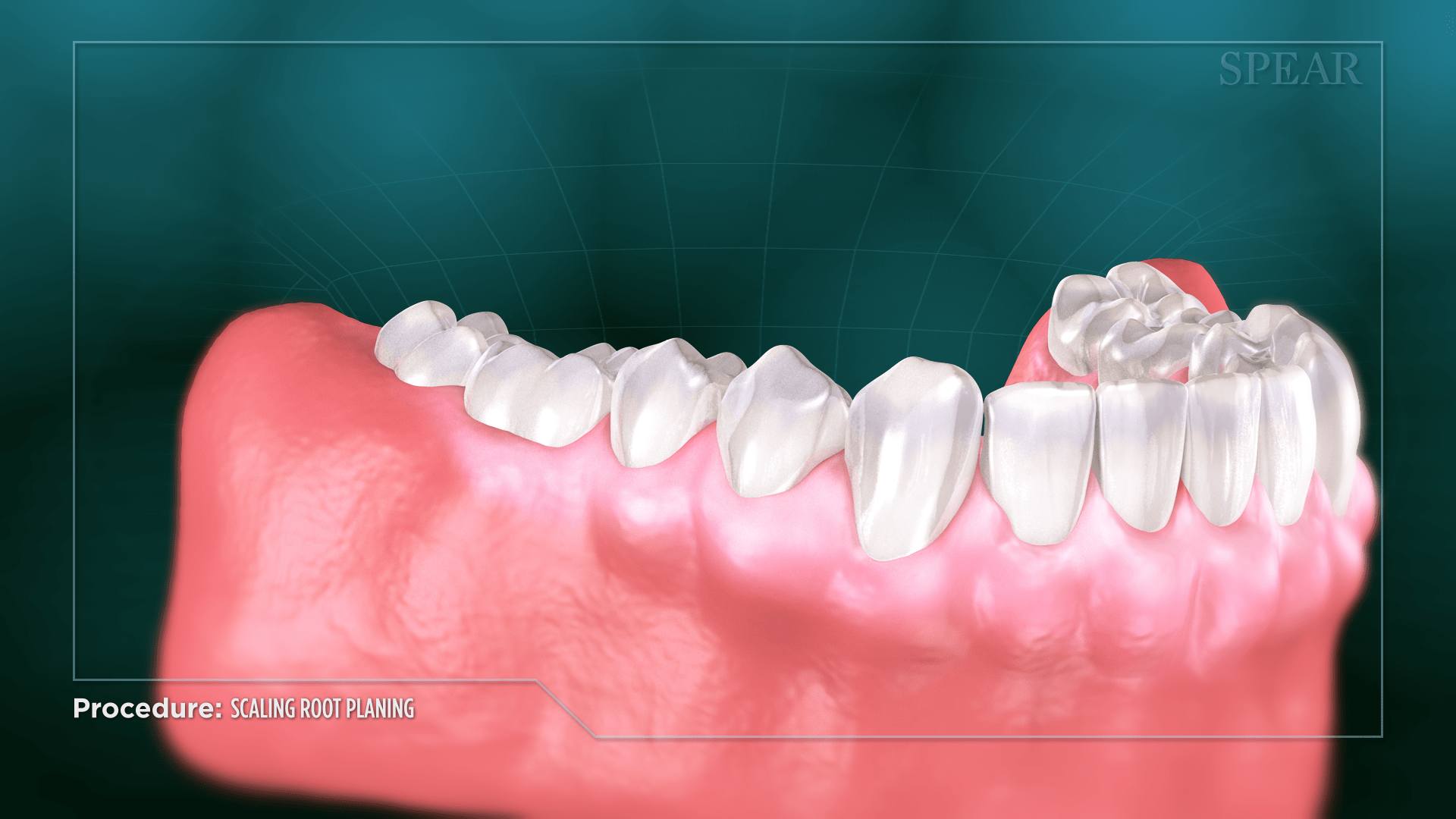 Periodontitis and Bone Loss Prevention at Lifetime Dentistry